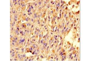 Immunohistochemistry of paraffin-embedded human melanoma using ABIN7172348 at dilution of 1:100 (TRAK1 antibody  (AA 101-300))