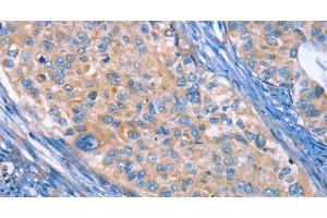 Immunohistochemistry of paraffin-embedded Human cervical cancer using CD61 Polyclonal Antibody at dilution of 1:30 (Integrin beta 3 antibody)