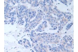 Detection of ALT in Human Breast cancer Tissue using Polyclonal Antibody to Alanine Aminotransferase (ALT) (ALT antibody  (AA 255-492))