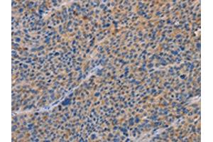 The image on the left is immunohistochemistry of paraffin-embedded Human liver cancer tissue using ABIN7192619(SPAG6 Antibody) at dilution 1/30, on the right is treated with synthetic peptide. (SPAG6 antibody)