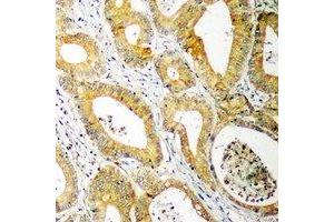 Immunohistochemical analysis of UBE2C staining in human colon cancer formalin fixed paraffin embedded tissue section. (UBE2C antibody)