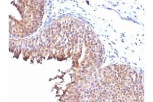 IHC testing of FFPE human bladder carcinoma with Keratin 10 antibody (clone KRT10/844). (Keratin 10 antibody)