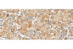 Immunohistochemistry of paraffin-embedded Human liver cancer tissue using CRABP1 Polyclonal Antibody at dilution of 1:120(x200) (CRABP1 antibody)