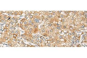 Immunohistochemistry of paraffin-embedded Human liver cancer tissue using CRABP1 Polyclonal Antibody at dilution of 1:120(x200) (CRABP1 antibody)