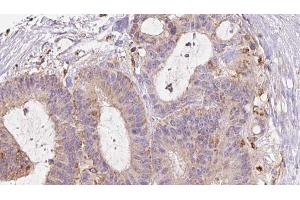 ABIN6272979 at 1/100 staining Human liver cancer tissue by IHC-P. (RAB3D antibody  (Internal Region))