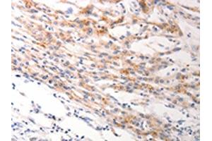 The image on the left is immunohistochemistry of paraffin-embedded Human lung cancer tissue using ABIN7191245(KRT6A/KRT6B/KRT6C Antibody) at dilution 1/40, on the right is treated with synthetic peptide. (KRT6A/KRT6B/KRT6C antibody)