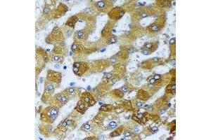 Immunohistochemical analysis of AMCase staining in human liver cancer formalin fixed paraffin embedded tissue section. (CHIA antibody)