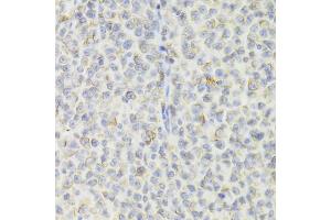 Immunohistochemistry of paraffin-embedded human B cell lymphoma using CD74 Antibody (ABIN1876868) at dilution of 1:100 (40x lens). (CD74 antibody)