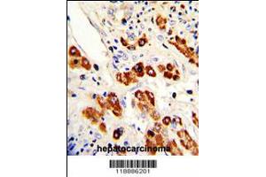 Formalin-fixed and paraffin-embedded human hepatocarcinoma with CEACAM Antibody (N-term), which was peroxidase-conjugated to the secondary antibody, followed by DAB staining. (CEACAM5 antibody  (N-Term))