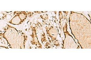 Immunohistochemistry of paraffin-embedded Human thyroid cancer tissue using NIPBL Polyclonal Antibody at dilution of 1:55(x200)
