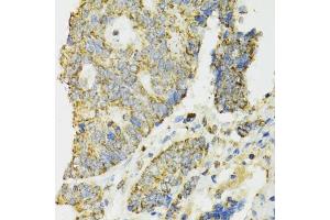 Immunohistochemistry of paraffin-embedded human colon carcinoma using IDH2 antibody.