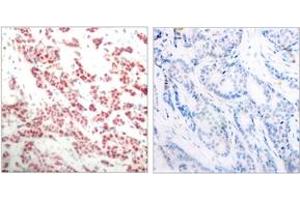 Immunohistochemistry analysis of paraffin-embedded human breast carcinoma, using NF-kappaB p100/p52 (Phospho-Ser865) Antibody. (NFKB2 antibody  (pSer866))