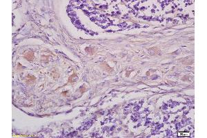 Formalin-fixed and paraffin embedded human lung carcinoma tissue labeled with Anti GRM1 Polyclonal Antibody,Unconjugated (bs1803R) at 1:200 followed by conjugation to the secondary antibody and DAB staining. (mGluR1 + mGluR5 antibody  (AA 651-750))