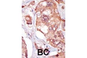 Formalin-fixed and paraffin-embedded human cancer tissue reacted with the primary antibody, which was peroxidase-conjugated to the secondary antibody, followed by AEC staining. (TNK1 antibody  (AA 256-286))