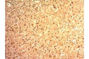 Immunohistochemical staining (Formalin-fixed paraffin-embedded sections) of human hepatocellular carcinoma with ARG1 monoclonal antibody, clone ARG1/1125 . (Liver Arginase antibody  (AA 1-150))