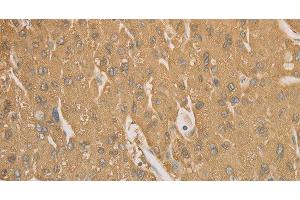 Immunohistochemistry of paraffin-embedded Human liver cancer tissue using CD40 Polyclonal Antibody at dilution 1:70 (CD40 antibody)