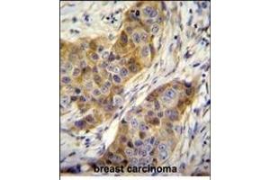 ANR39 Antibody (C-term) (ABIN655104 and ABIN2844736) immunohistochemistry analysis in formalin fixed and paraffin embedded human breast carcinoma followed by peroxidase conjugation of the secondary antibody and DAB staining. (ANKRD39 antibody  (C-Term))