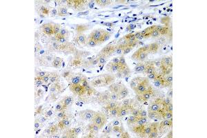 Immunohistochemistry of paraffin-embedded human liver cancer using RARRES2 antibody (ABIN5974187) at dilution of 1/200 (40x lens). (Chemerin antibody)