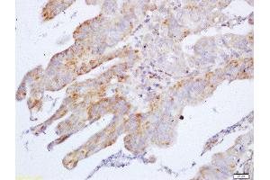Formalin-fixed and paraffin embedded human gastric carcinoma labeled with Anti-Cyclin M2 Polyclonal Antibody, Unconjugated  at 1:200 followed by conjugation to the secondary antibody and DAB staining