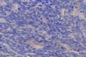 Immunohistochemistry analysis of paraffin-embedded human colon cancer using TGT (ABIN7076024) at dilution of 1: 6400 (tRNA-Guanine Transglycosylase antibody)