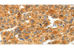Immunohistochemistry of paraffin-embedded Human liver cancer tissue using STXBP4 Polyclonal Antibody at dilution 1:40