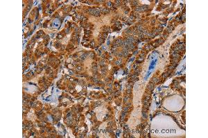 Immunohistochemistry of Human cervical cancer using MBNL3 Polyclonal Antibody at dilution of 1:30