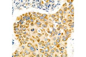 Immunohistochemistry of paraffin embedded human lung cancer using Notch4 (ABIN7074863) at dilution of 1:600 (400x lens) (NOTCH4 antibody)