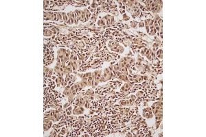 Immunohistochemical analysis of (ABIN657470 and ABIN2846498) on paraffin-embedded Human breast carcinoma tissue.