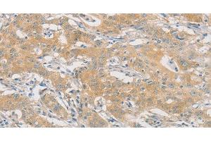 Immunohistochemistry of paraffin-embedded Human gasrtic cancer tissue using HIPK4 Polyclonal Antibody at dilution 1:30 (HIPK4 antibody)