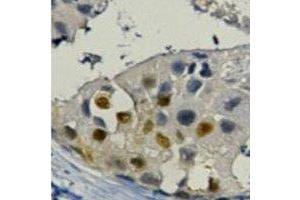 Immunohistochemical analysis of PCNA staining in human breast cancer formalin fixed paraffin embedded tissue section. (PCNA antibody)
