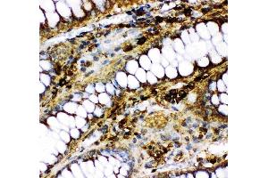 Anti-p73 antibody, (ABIN3043469), IHC(P)IHC(P): Human Intestinal Cancer Tissue