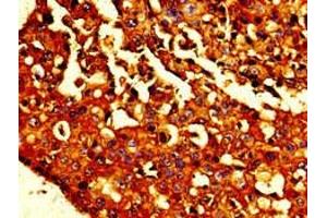 Immunohistochemistry of paraffin-embedded human breast cancer using ABIN7146190 at dilution of 1:100