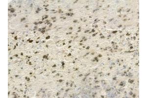 ABIN6256146 and ABIN6267380 at 1/100 staining human melanoma by IHC-P.