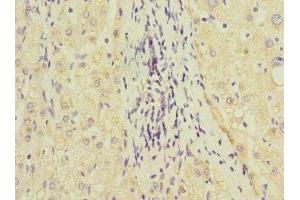 Immunohistochemistry of paraffin-embedded human liver cancer using ABIN7154098 at dilution of 1:100 (GSTK1 antibody  (AA 1-226))