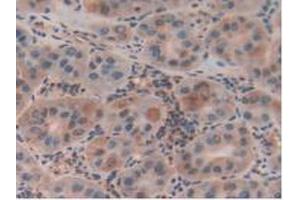 Detection of CLIC1 in Human Liver Cancer Tissue using Polyclonal Antibody to Chloride Intracellular Channel Protein 1 (CLIC1) (CLIC1 antibody  (AA 79-241))