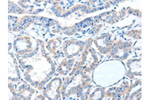 The image on the left is immunohistochemistry of paraffin-embedded Human thyroid cancer tissue using ABIN7128233(ADAM21 Antibody) at dilution 1/15, on the right is treated with fusion protein. (ADAM21 antibody)