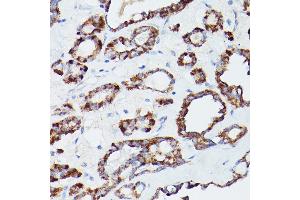 Immunohistochemistry of paraffin-embedded human thyroid cancer using L1 Rabbit pAb (ABIN6134555, ABIN6137248, ABIN6137250 and ABIN6215529) at dilution of 1:100 (40x lens). (ATG16L1 antibody  (AA 200-300))