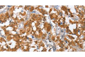 Immunohistochemistry of paraffin-embedded Human thyroid cancer using TP53BP2 Polyclonal Antibody at dilution of 1:35 (TP53BP2 antibody)