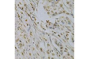 Immunohistochemistry of paraffin-embedded human gastric cancer using SUMO1 Antibody (ABIN5971157) at dilution of 1/200 (40x lens). (SUMO1 antibody)