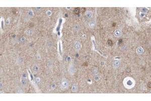 ABIN6278481 at 1/100 staining Human brain cancer tissue by IHC-P. (IL20RA antibody  (C-Term))