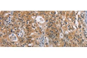 Immunohistochemistry of paraffin-embedded Human gastric cancer tissue using ZADH2 Polyclonal Antibody at dilution of 1:100(x200) (ZADH2 antibody)