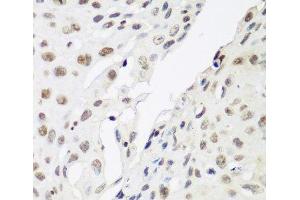 Immunohistochemistry of paraffin-embedded Human lung cancer using CBX3 Polyclonal Antibody at dilution of 1:200 (40x lens). (CBX3 antibody)