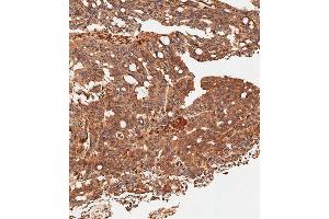 Immunohistochemical analysis of paraffin-embedded Human colon carcinoma tissue using (ABIN656331 and ABIN2845630) performed on the Leica® BOND RXm. (SLC16A3 antibody  (C-Term))