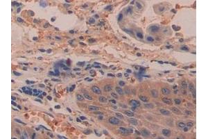 Detection of DDAH2 in Human Stomach cancer Tissue using Polyclonal Antibody to Dimethylarginine Dimethylaminohydrolase 2 (DDAH2)