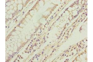 Immunohistochemistry of paraffin-embedded human colon cancer using ABIN7173269 at dilution of 1:100 (TMEM71 antibody  (AA 1-210))