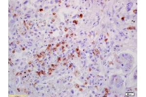 Formalin-fixed and paraffin embedded human lung carcinoma labeled with Anti-IL-7 Polyclonal Antibody, Unconjugated (ABIN734783) at 1:200 followed by conjugation to the secondary antibody and DAB staining