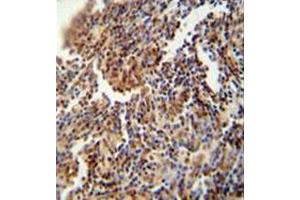 Immunohistochemistry analysis in formalin fixed and paraffin embedded human lung carcinoma reacted with HFM1 Antibody (C-term) followed which was peroxidase conjugated to the secondary antibody and followed by DAB staining. (HFM1 antibody  (C-Term))