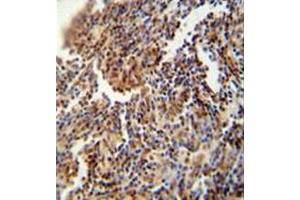 Immunohistochemistry analysis in formalin fixed and paraffin embedded human lung carcinoma reacted with HFM1 Antibody (C-term) followed which was peroxidase conjugated to the secondary antibody and followed by DAB staining. (HFM1 antibody  (C-Term))