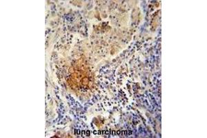 TYROBP Antibody (C-term) immunohistochemistry analysis in formalin fixed and paraffin embedded human lung carcinoma followed by peroxidase conjugation of the secondary antibody and DAB staining. (TYROBP antibody  (C-Term))