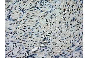 Immunohistochemical staining of paraffin-embedded Adenocarcinoma of ovary tissue using anti-TMEM100mouse monoclonal antibody. (TMEM100 antibody)